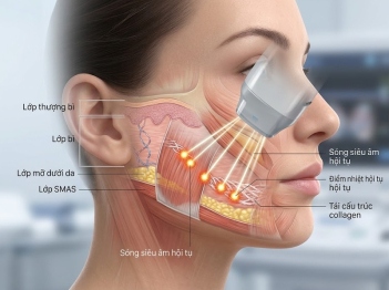 Công nghệ HIFU hoạt động trong làm đẹp thế nào?