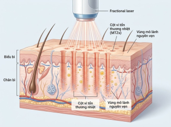 Laser fractional hoạt động và tác động lên da thế nào?