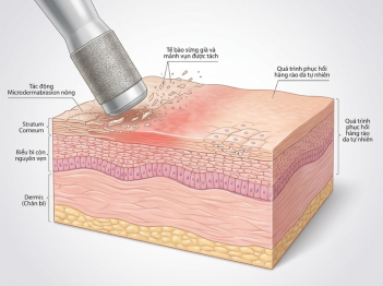 Microdermabrasion tác động lên bề mặt da như thế nào?